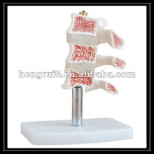 ISO Osteoporosis Model,cut lumbar vertebrae model, spinal column joint skeleton HR-134